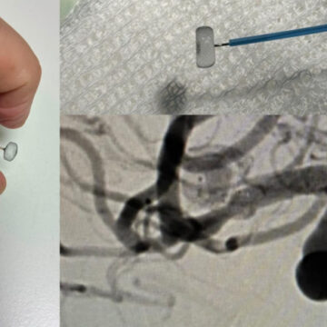 Inédita intervención endovascular en el Hospital “San Martín” de La Plata