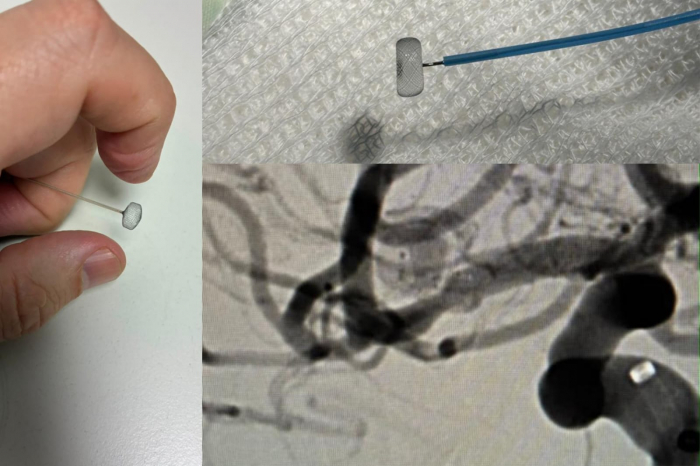 Inédita intervención endovascular en el Hospital “San Martín” de La Plata Inédita intervención endovascular en el Hospital “San Martín” de La Plata